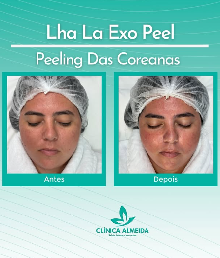 Resultado de peeling facial com comparação antes e depois