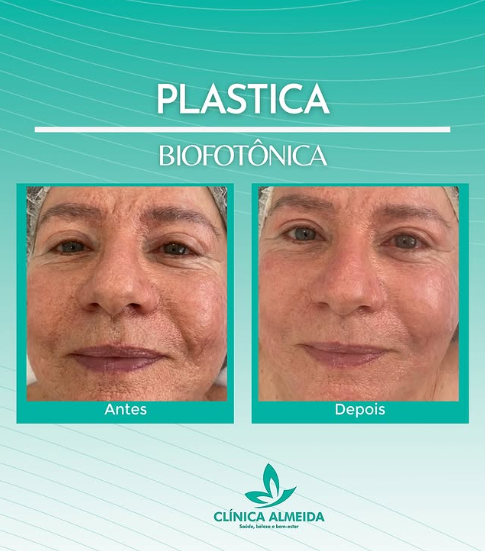 Resultado de plástica biofônica com comparação antes e depois